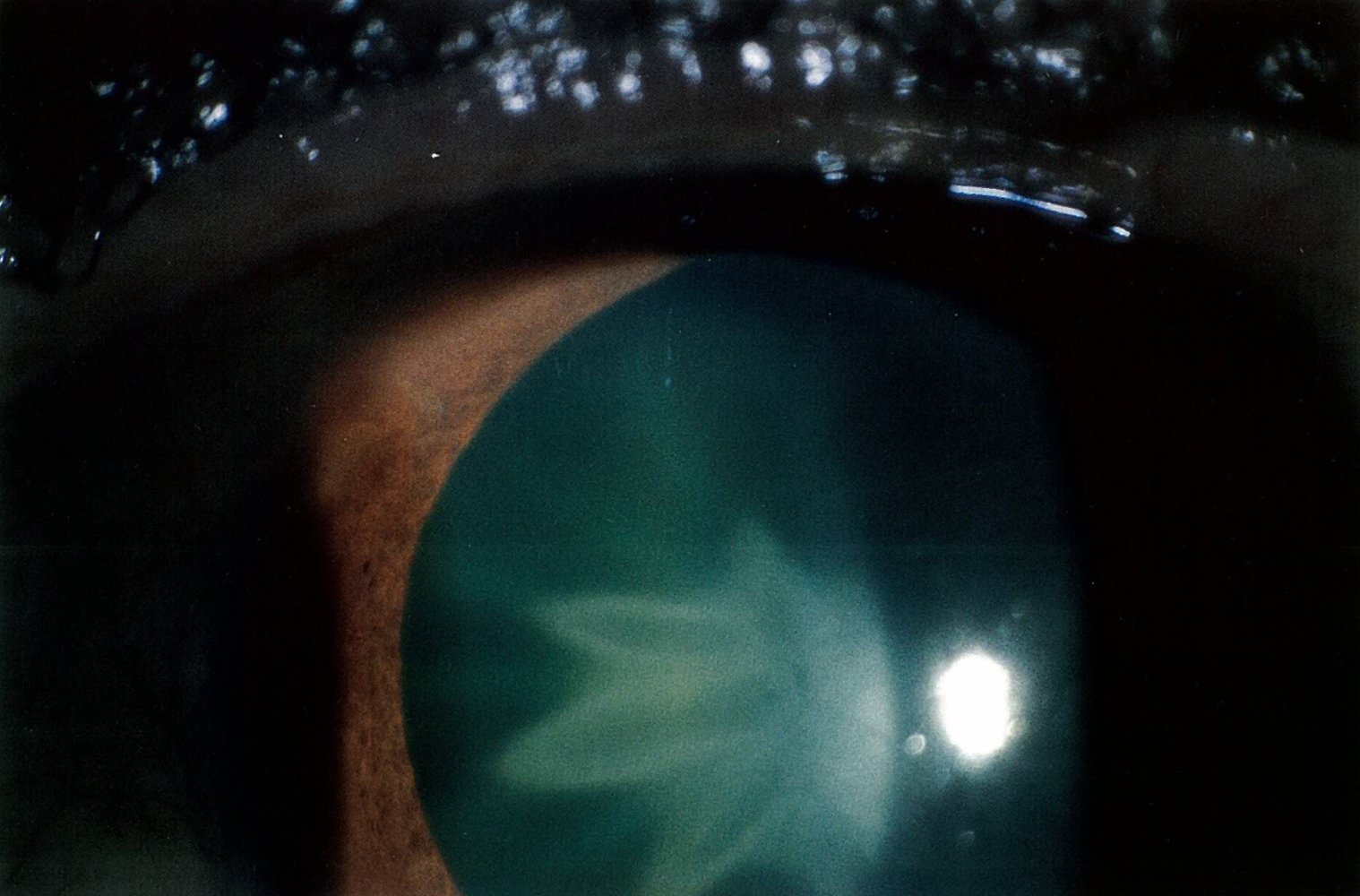 Traumatic cataract (contusion cataract)