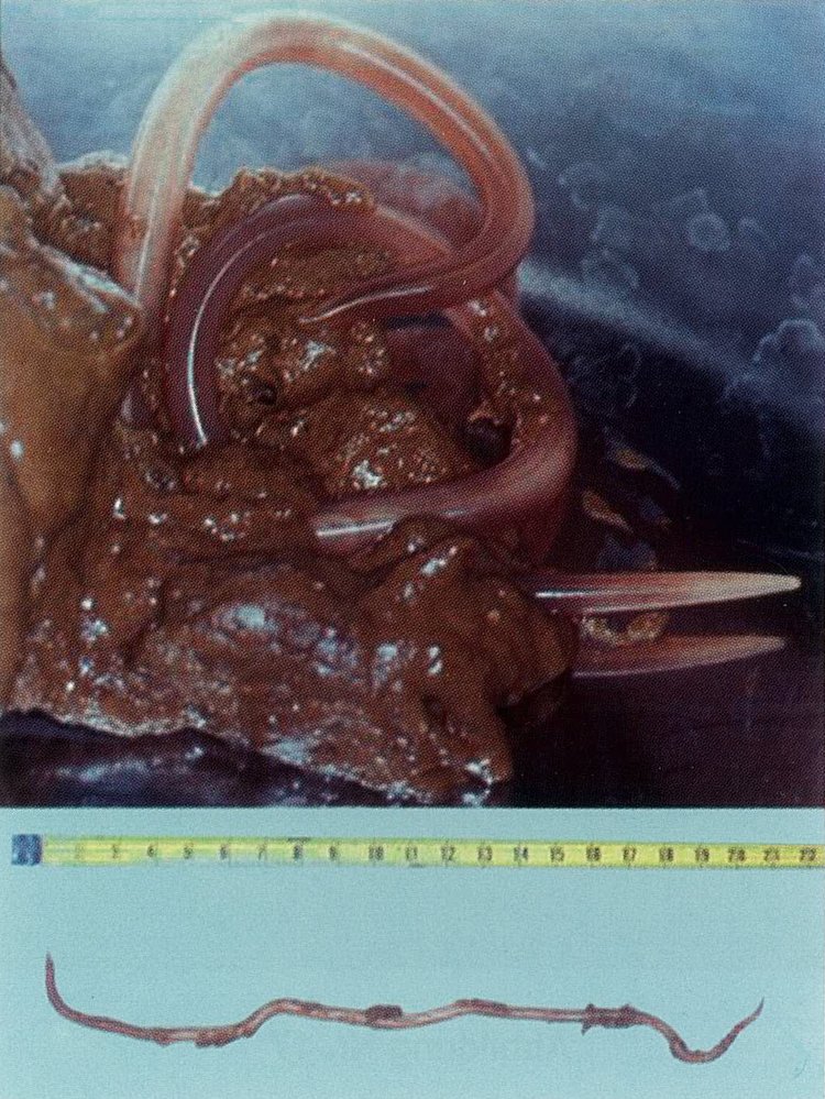 Ascaris lumbricoides (giant roundworm)