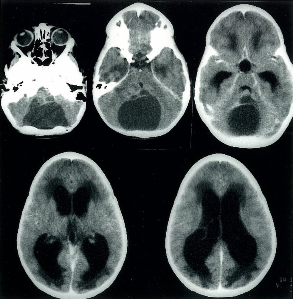 Noncommunicating hydrocephalus