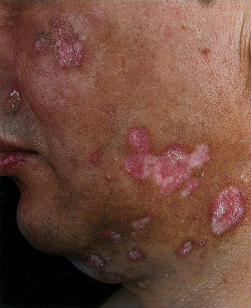 Discoid lupus erythematosus