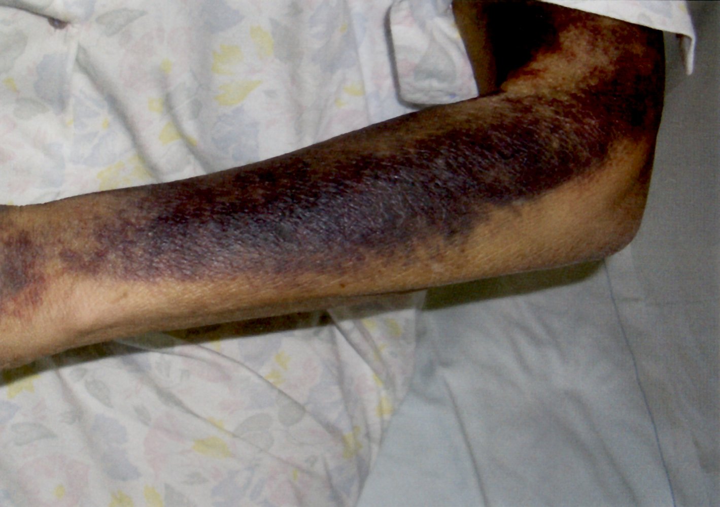 Impaired secondary hemostasis in lupus erythematosus