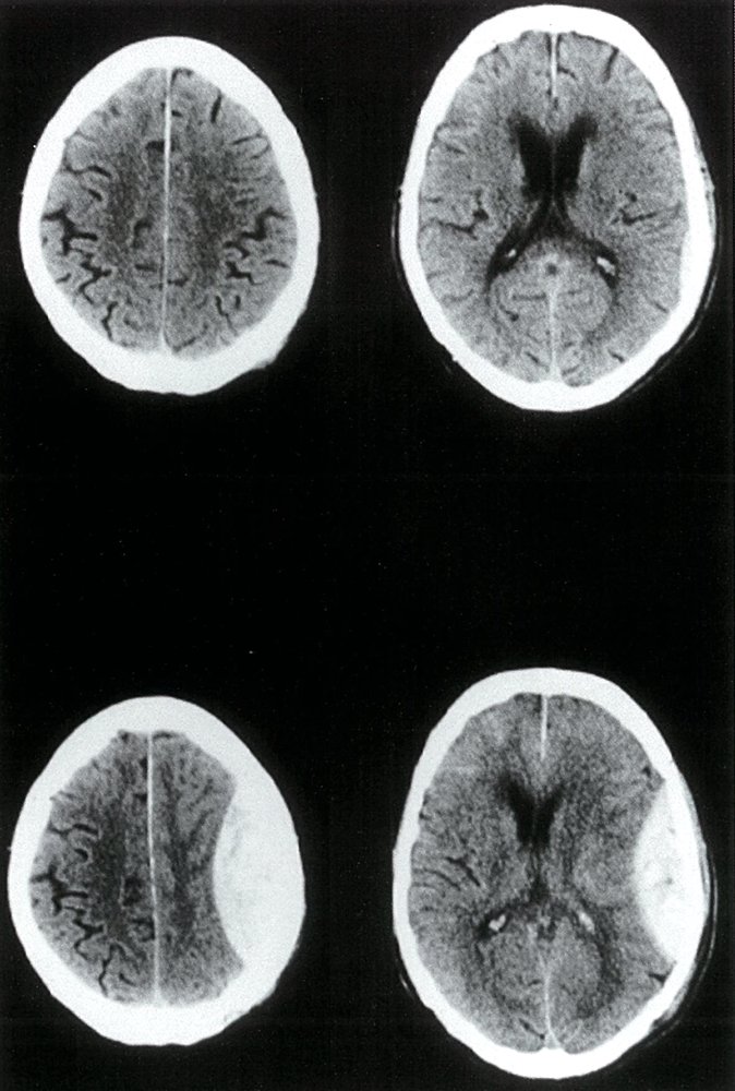 Epidural hematoma