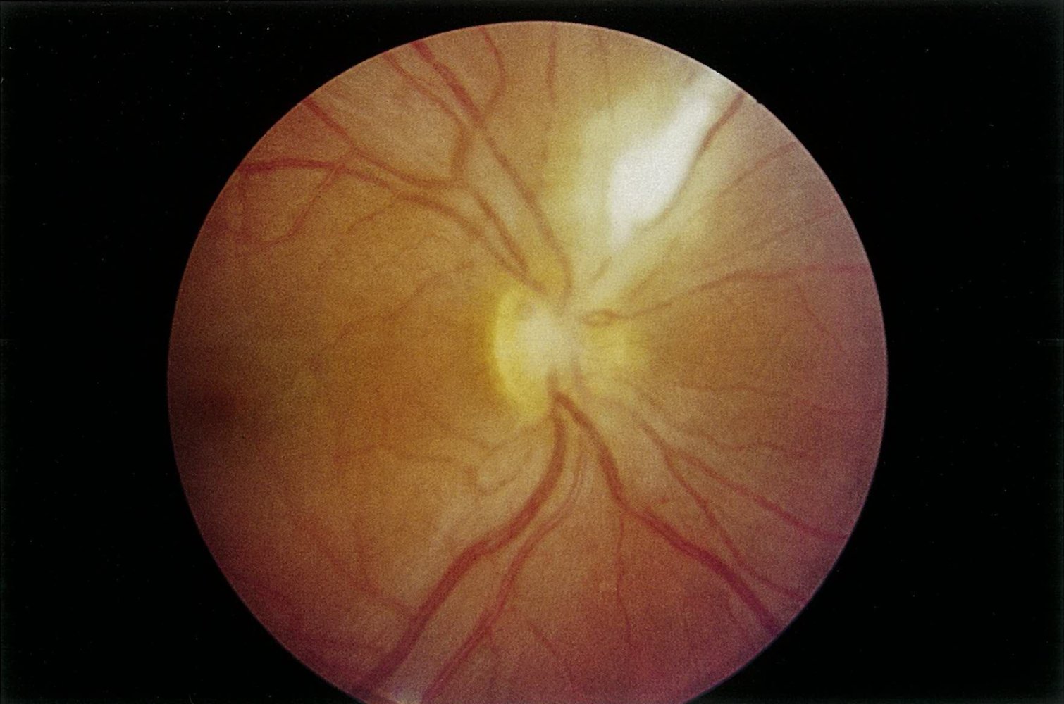 Juxtapapillary retinochoroiditis (Jensen disease)