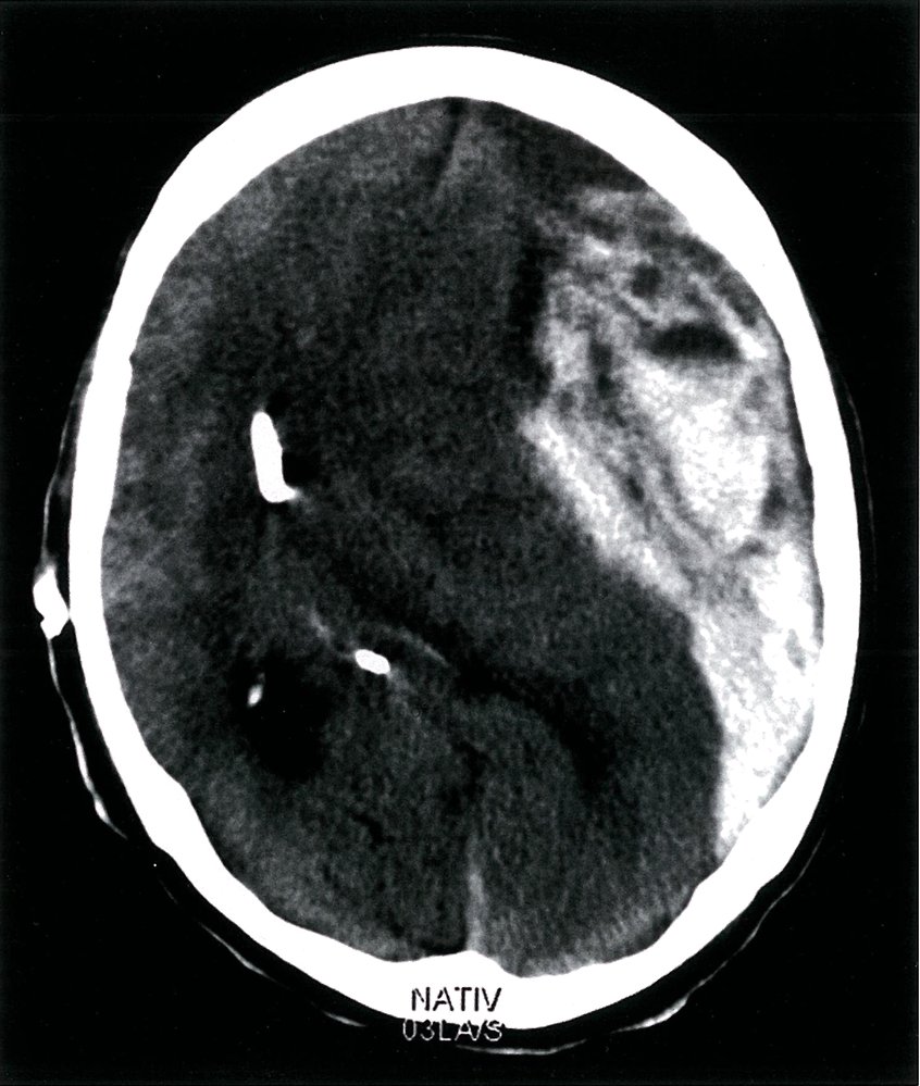 Subdural hematoma