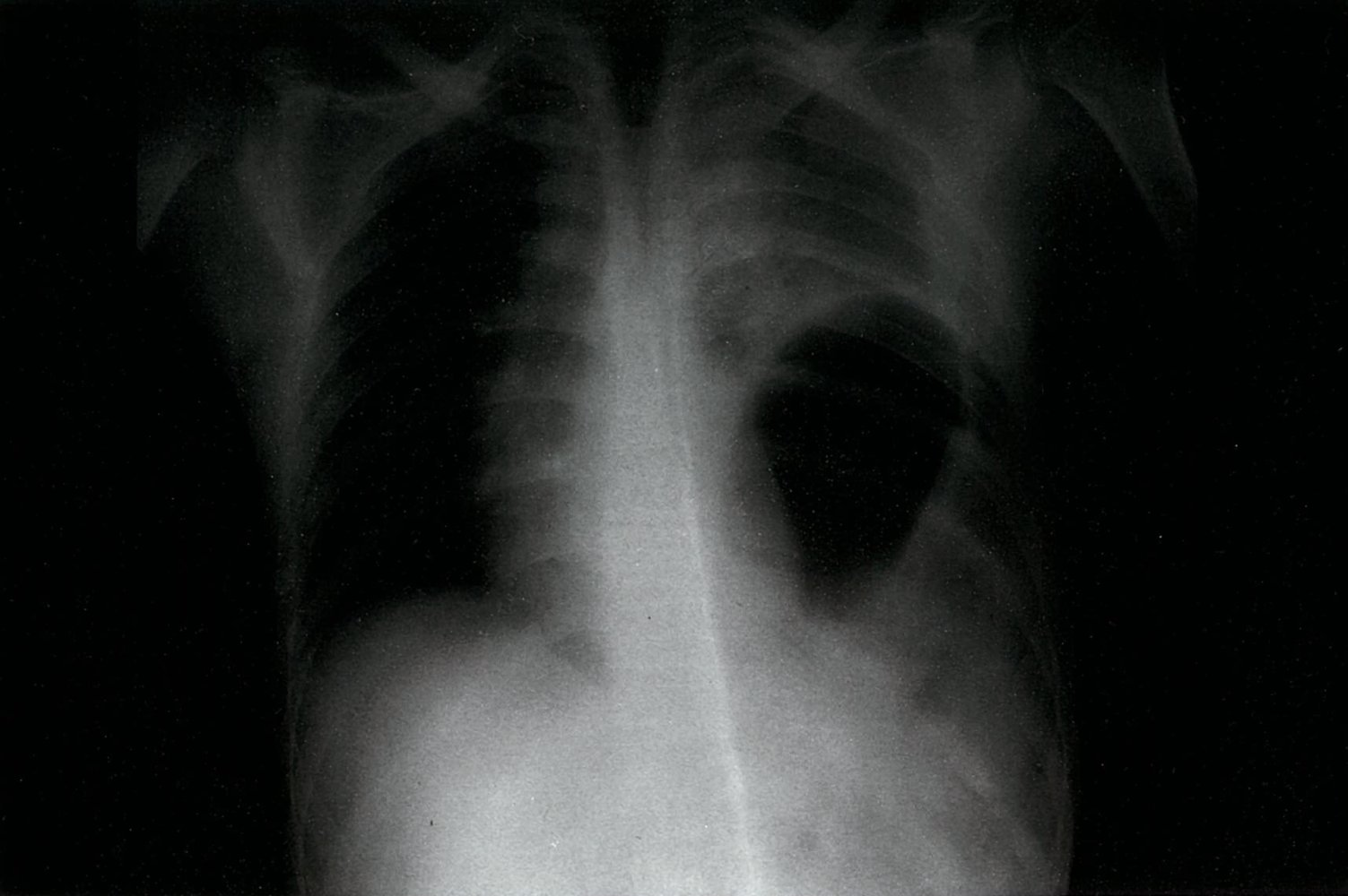 Left diaphragmatic rupture