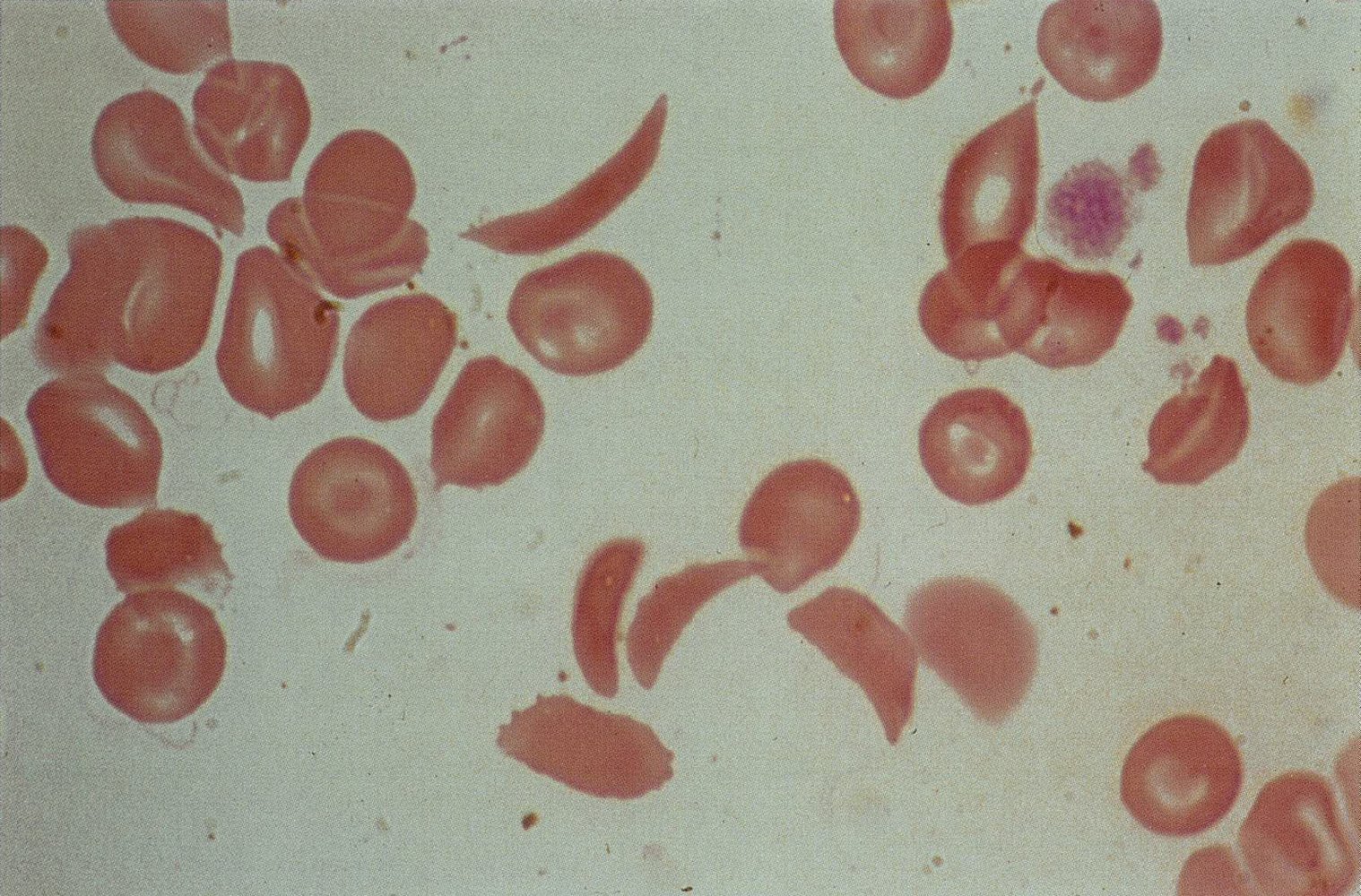 Sickle cell disease with drepanocytes and target cells