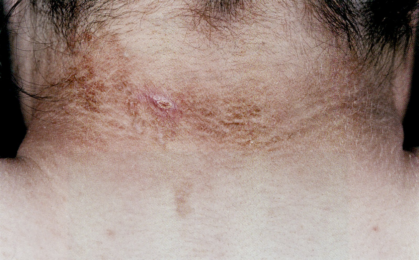 Pseudoacanthosis nigricans