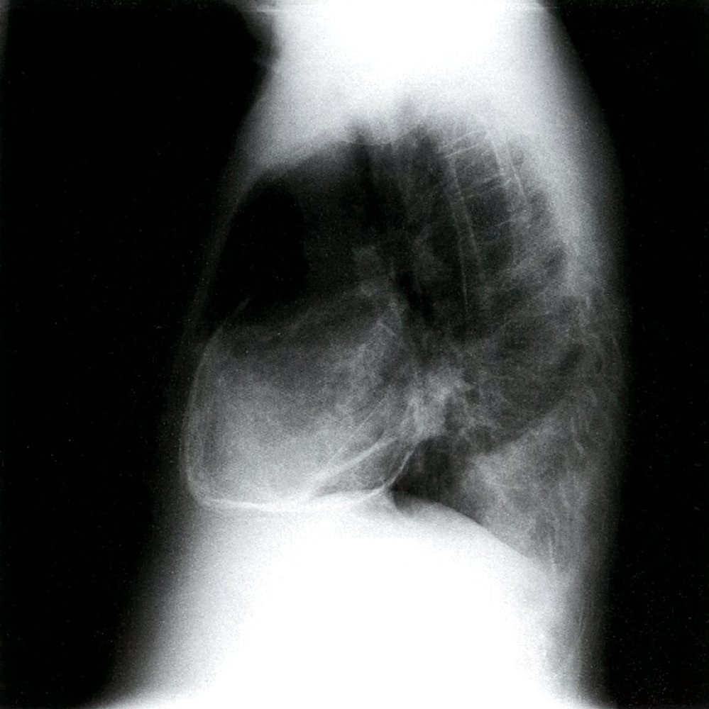 Constrictive pericarditis