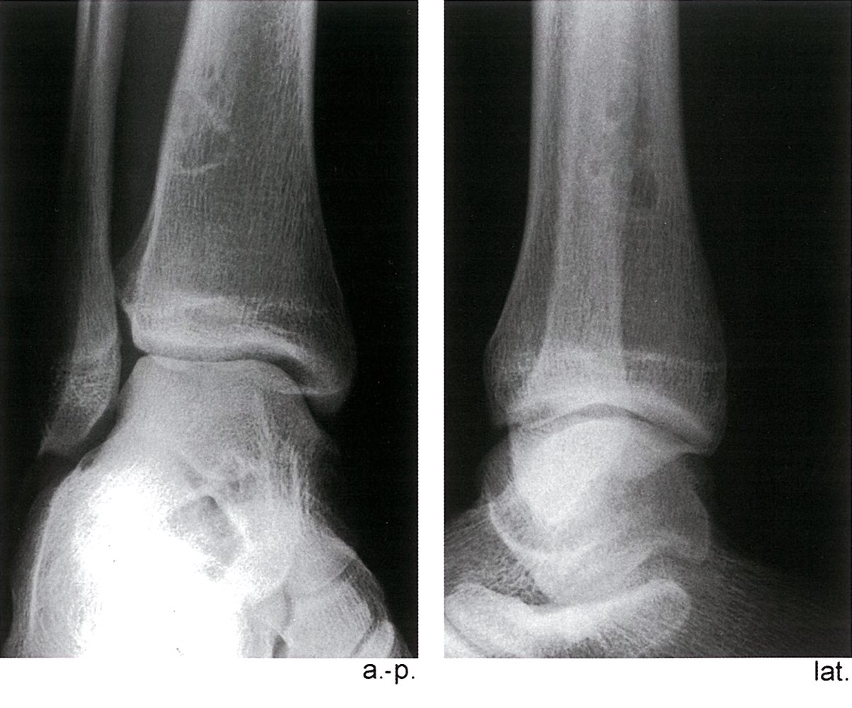 Nonossifying fibroma