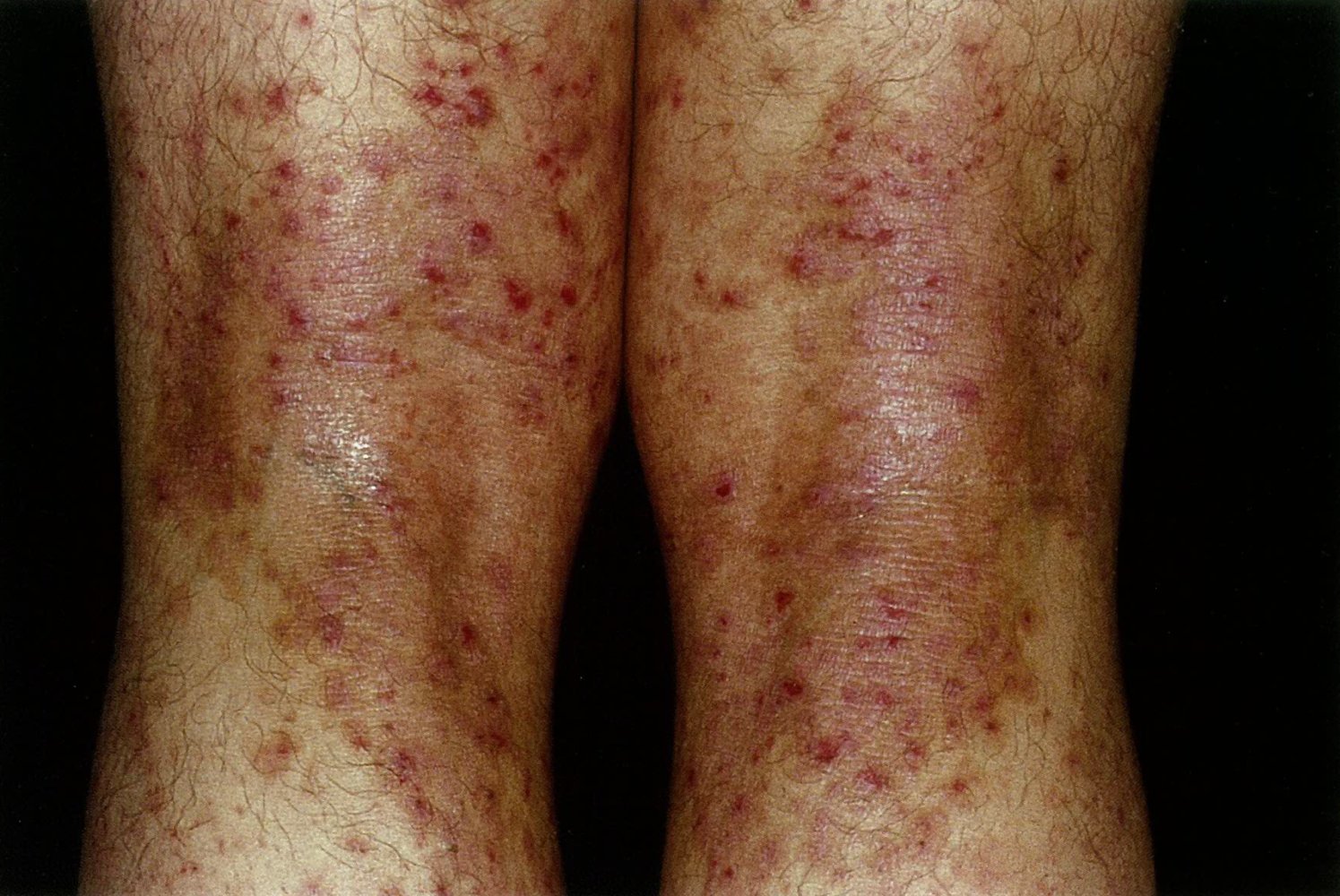 Atopic dermatitis