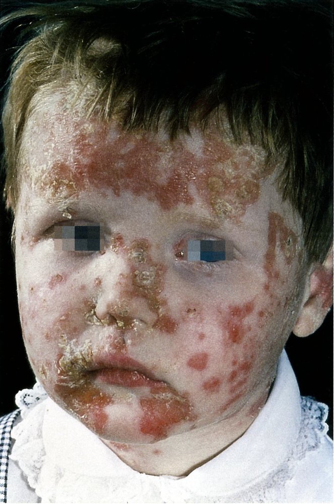 Nonbullous impetigo