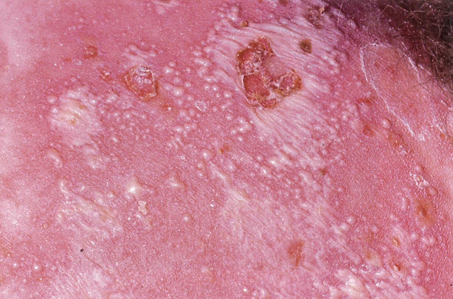 Generalized pustular psoriasis