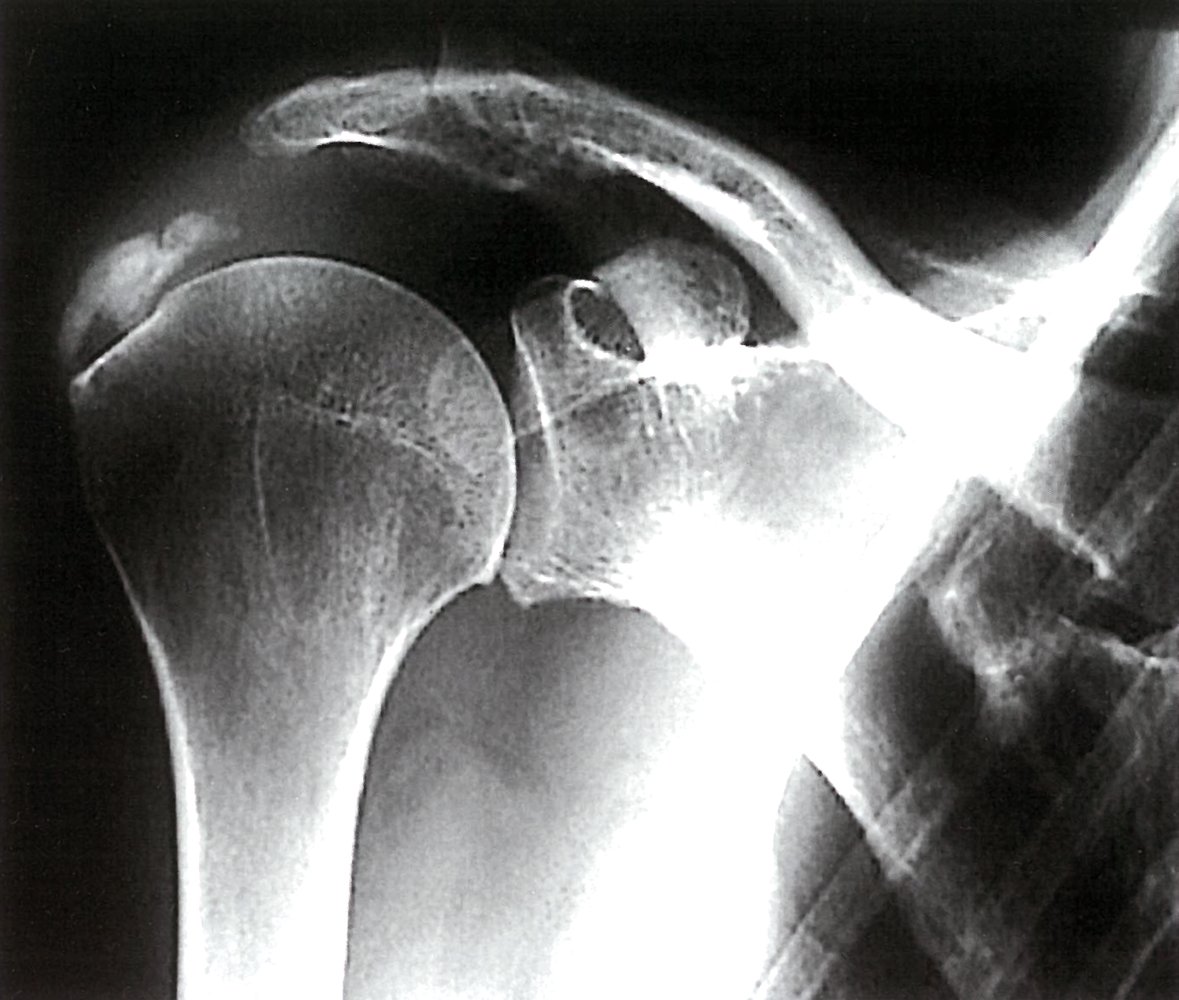 Basic calcium phosphate-associated calcific periarthritis (calcific tendinitis)