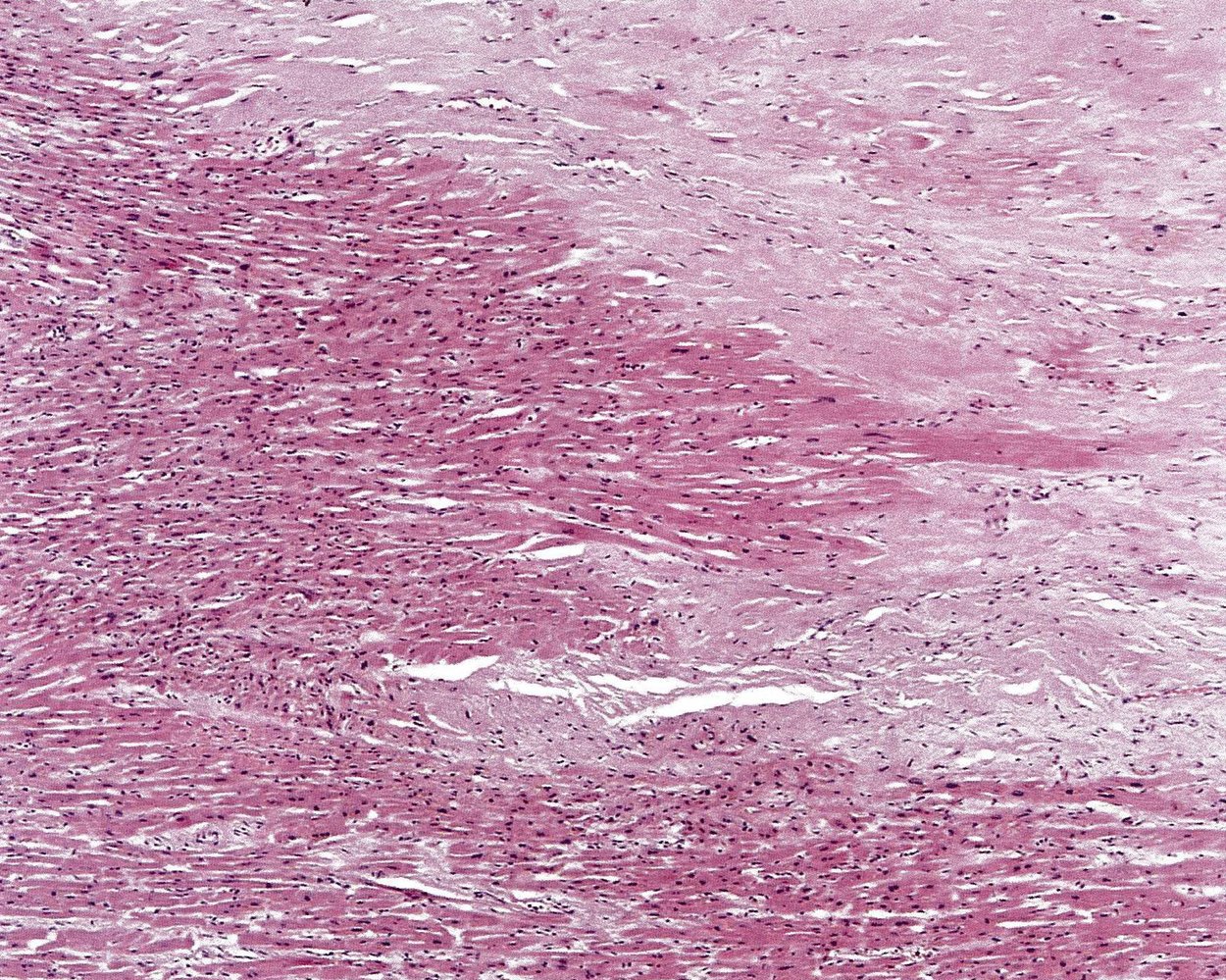 Myocardial scar (post infarction)