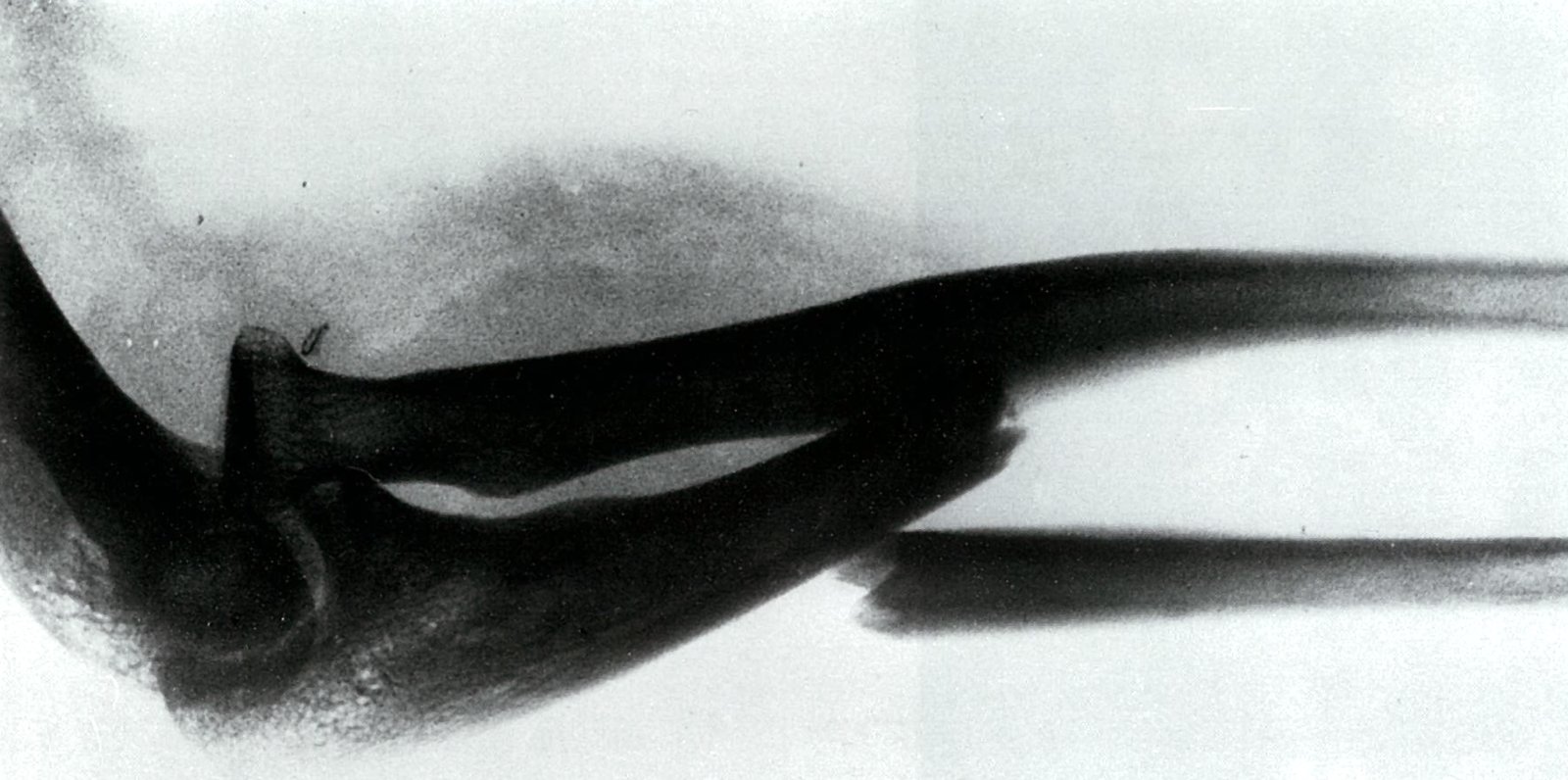 Monteggia fracture-dislocation