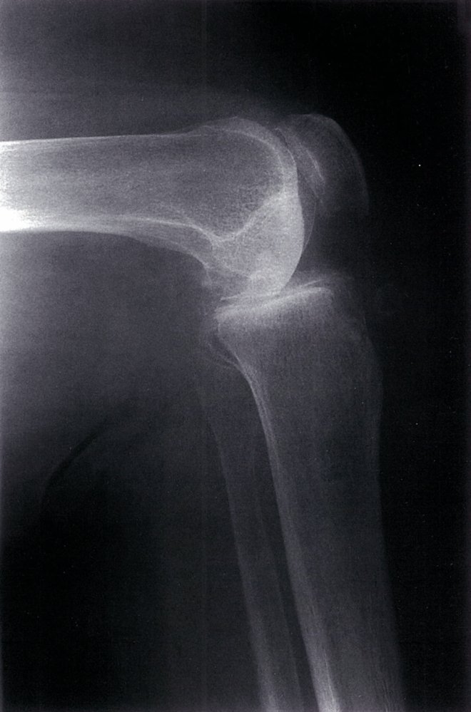 Osteoarthritis of the knee