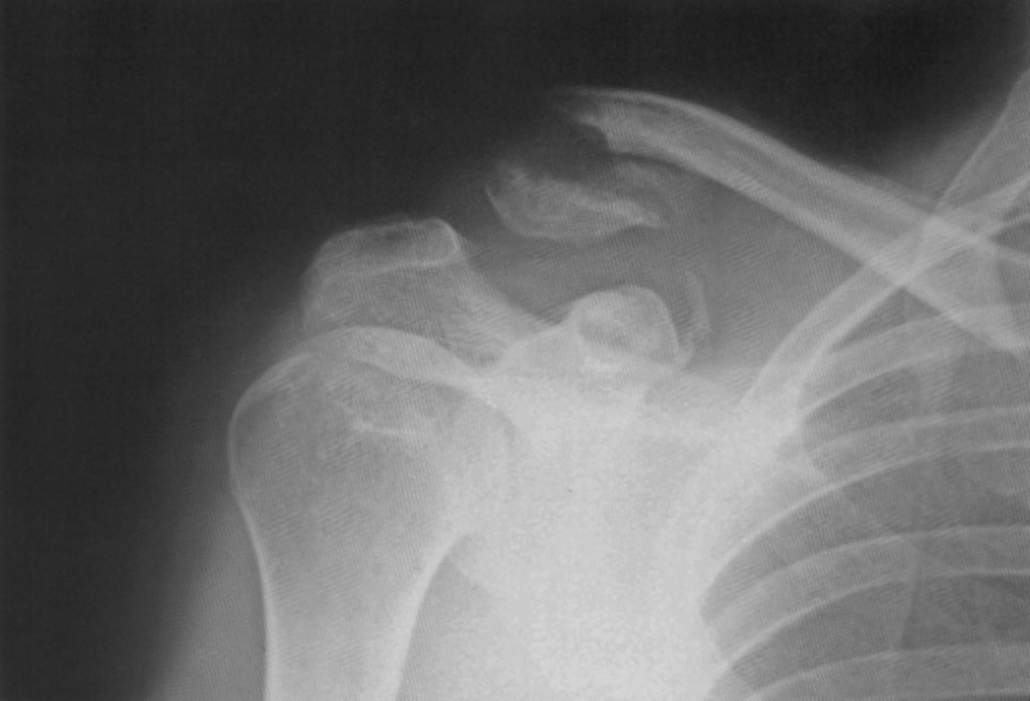 Lateral clavicle fracture
