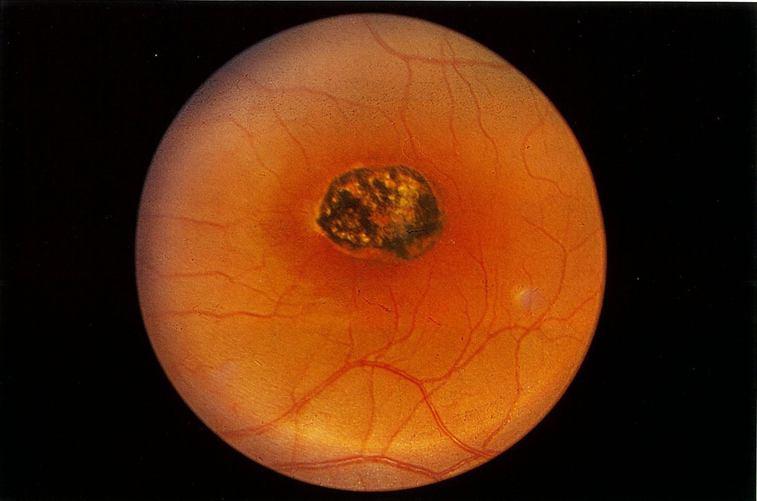 Macular scar in congenital toxoplasmosis