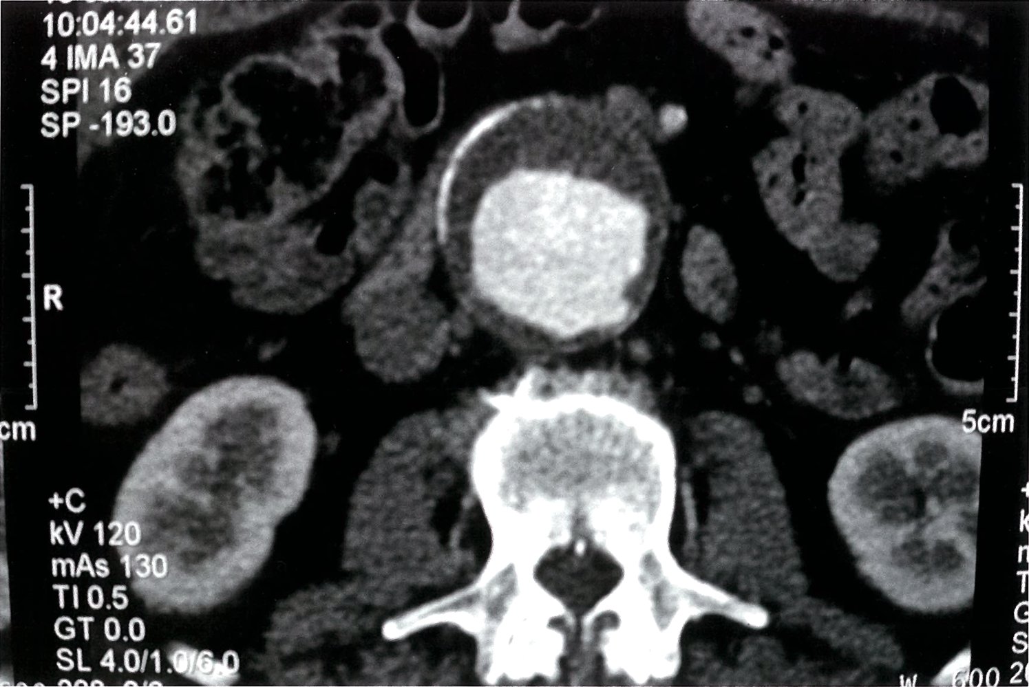 Infrarenal abdominal aortic aneurysm