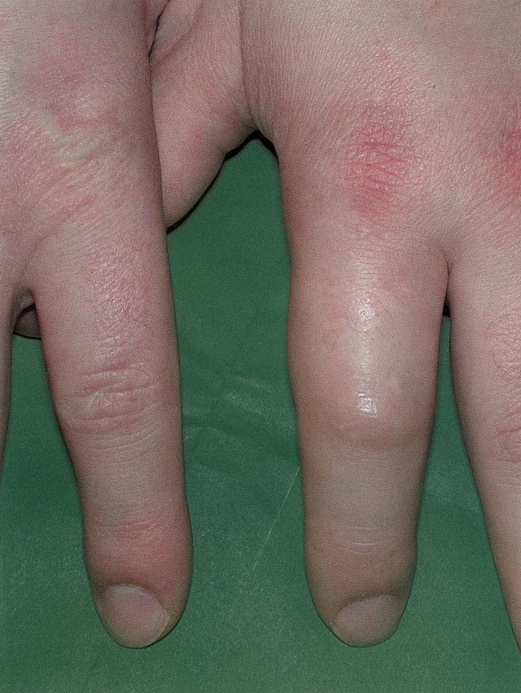 Dactylitis