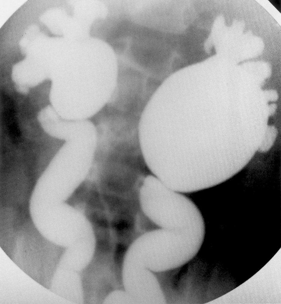 Refluxing megaureter in a voiding cystourethrogram (1/2)