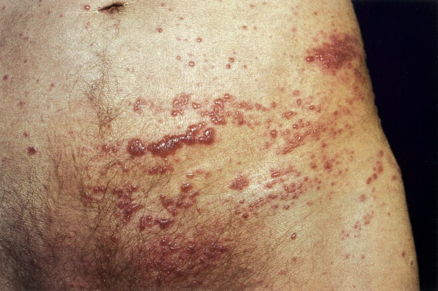 Shingles