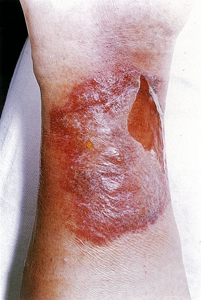 Erysipelas