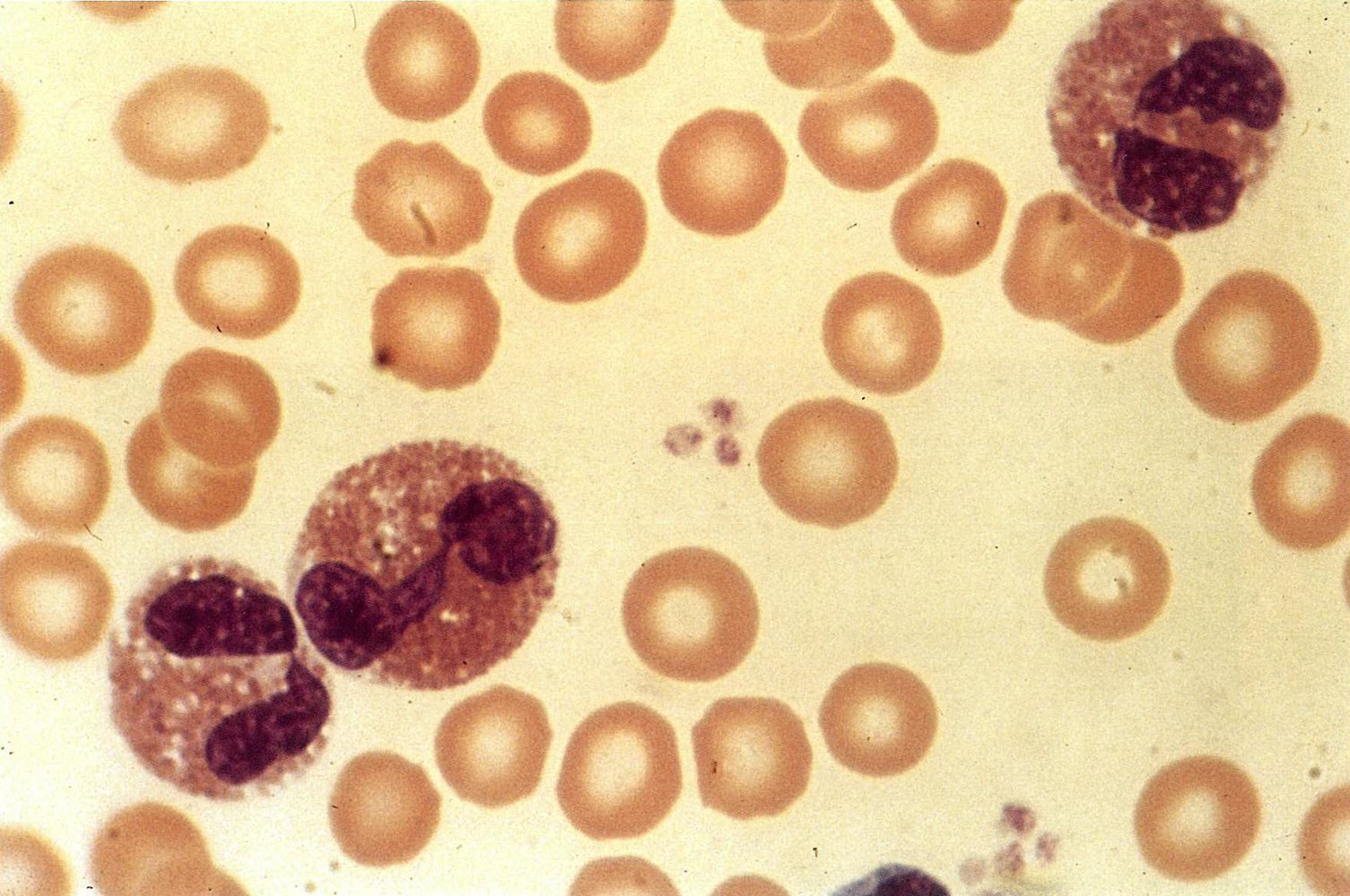 Eosinophilia in toxocariasis