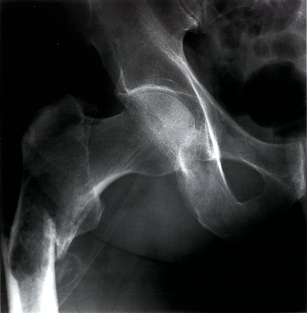 Pathologic femoral fracture