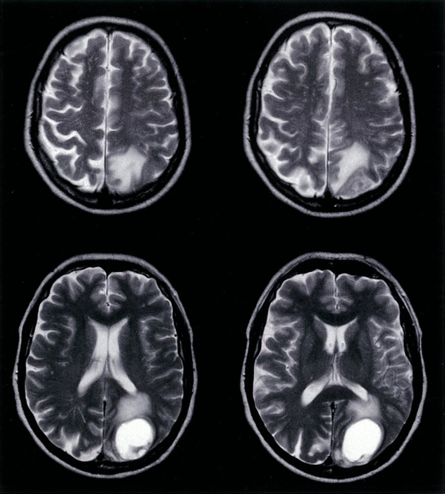 Cerebral metastasis in lung carcinoma 2/2