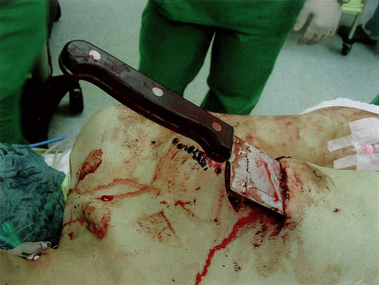Stab wound to the chest