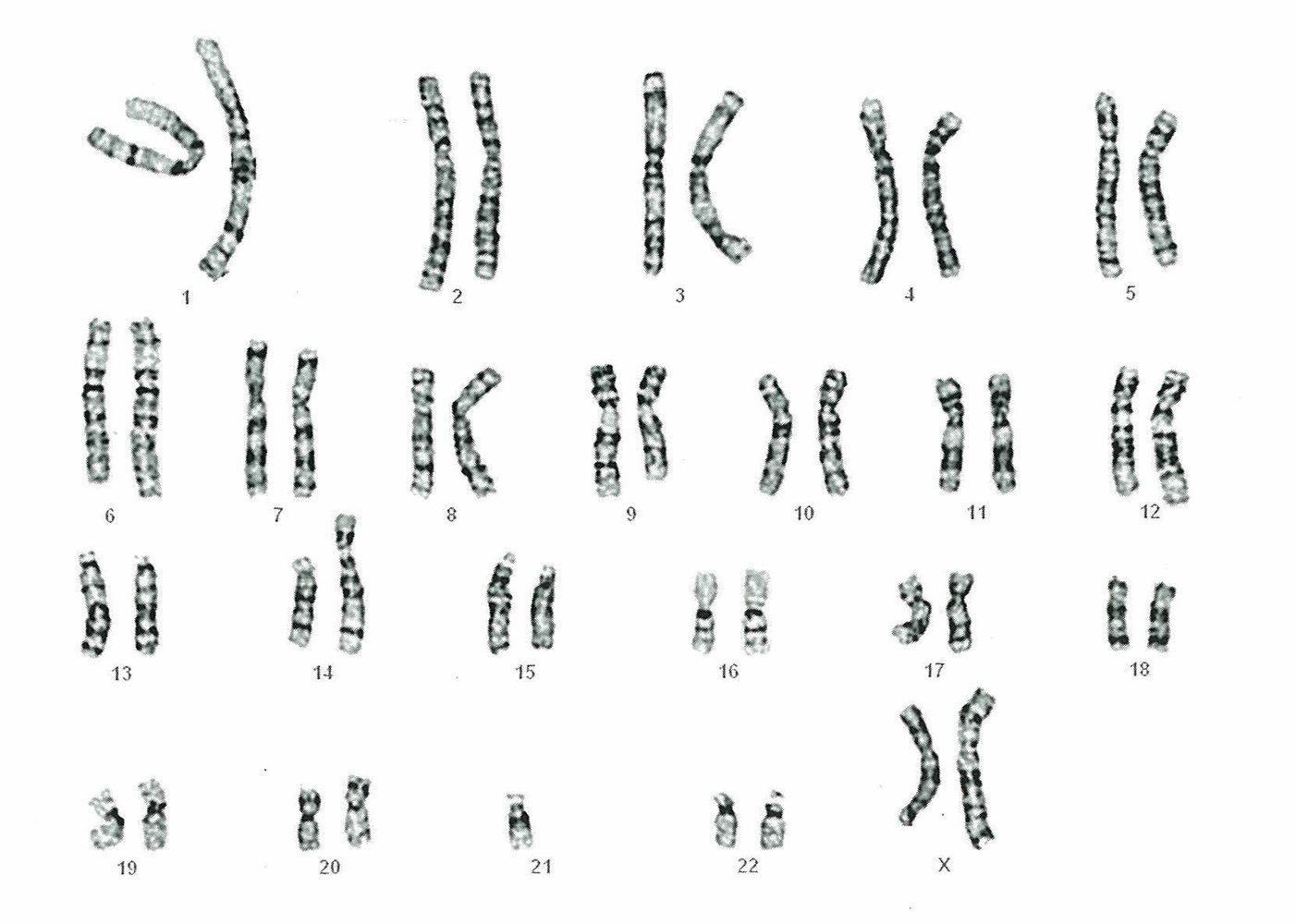 Karyogram in balanced Robertsonian translocation (14/21)