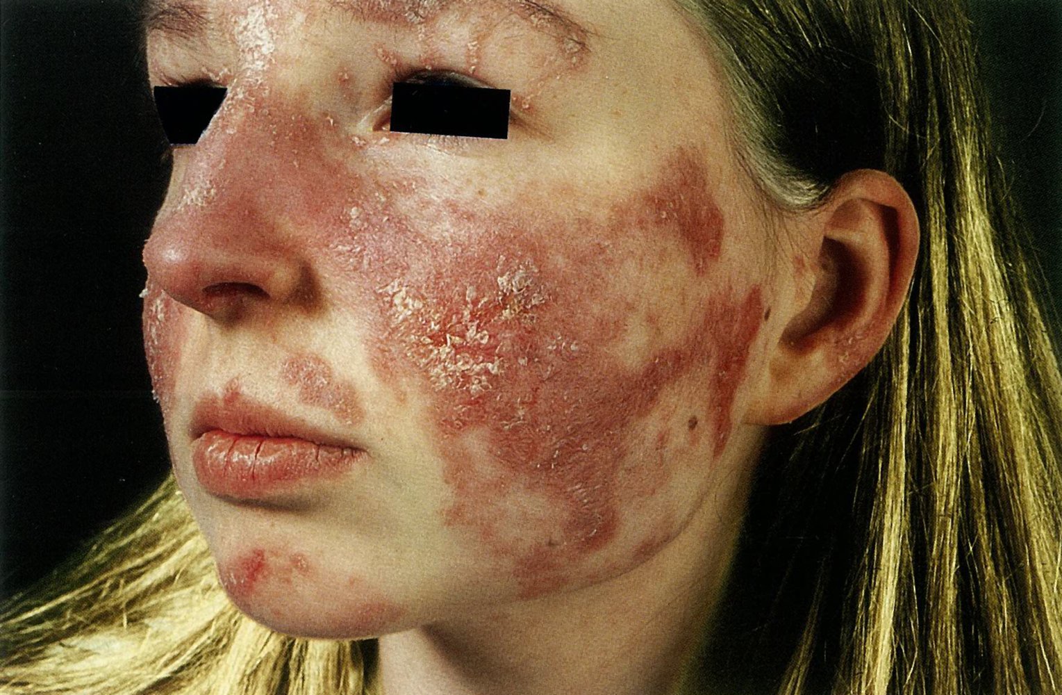 Malar rash in systemic lupus erythematosus