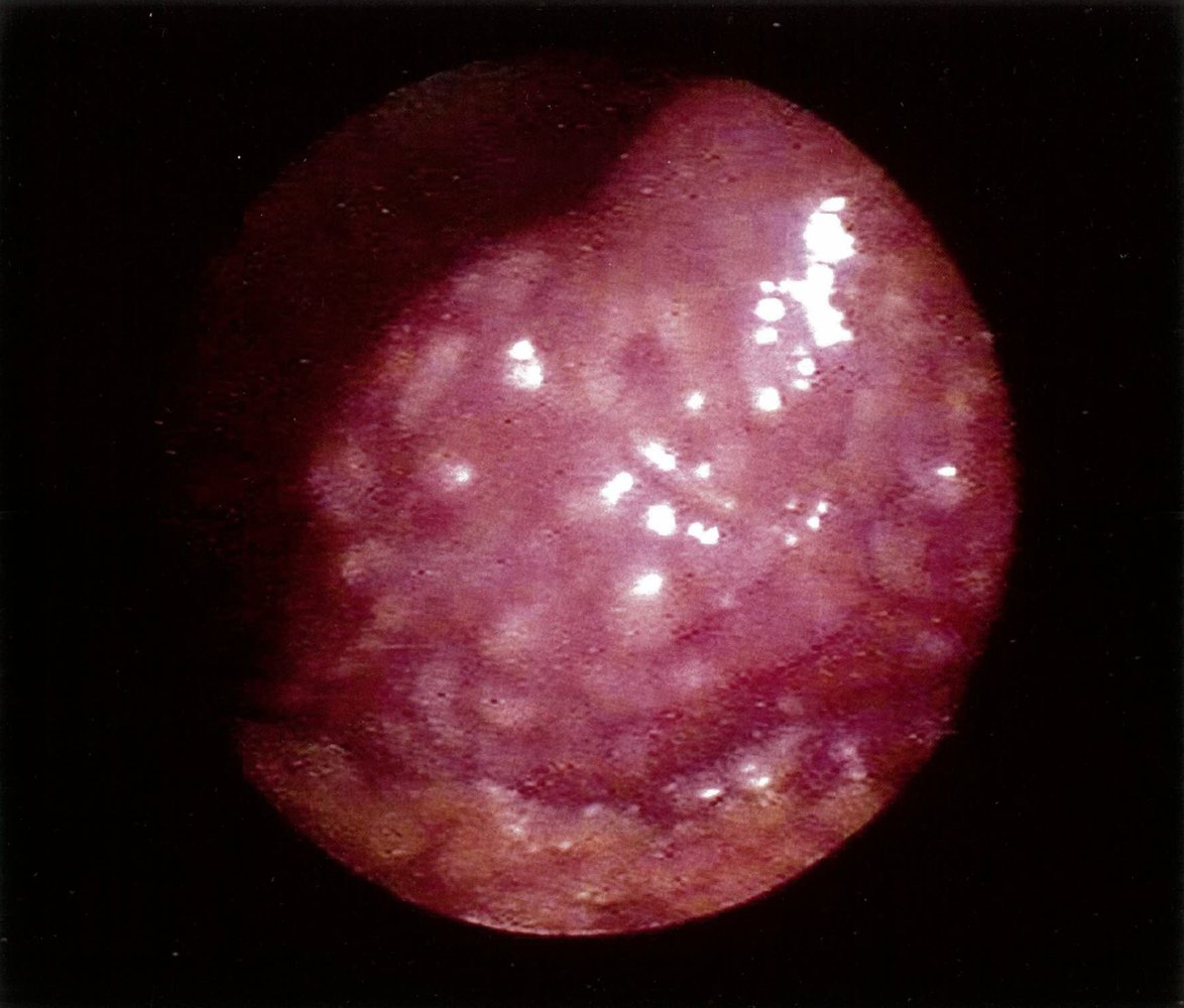 Micronodular cirrhosis
