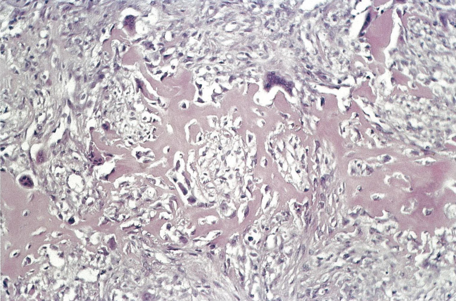 Osteosarcoma