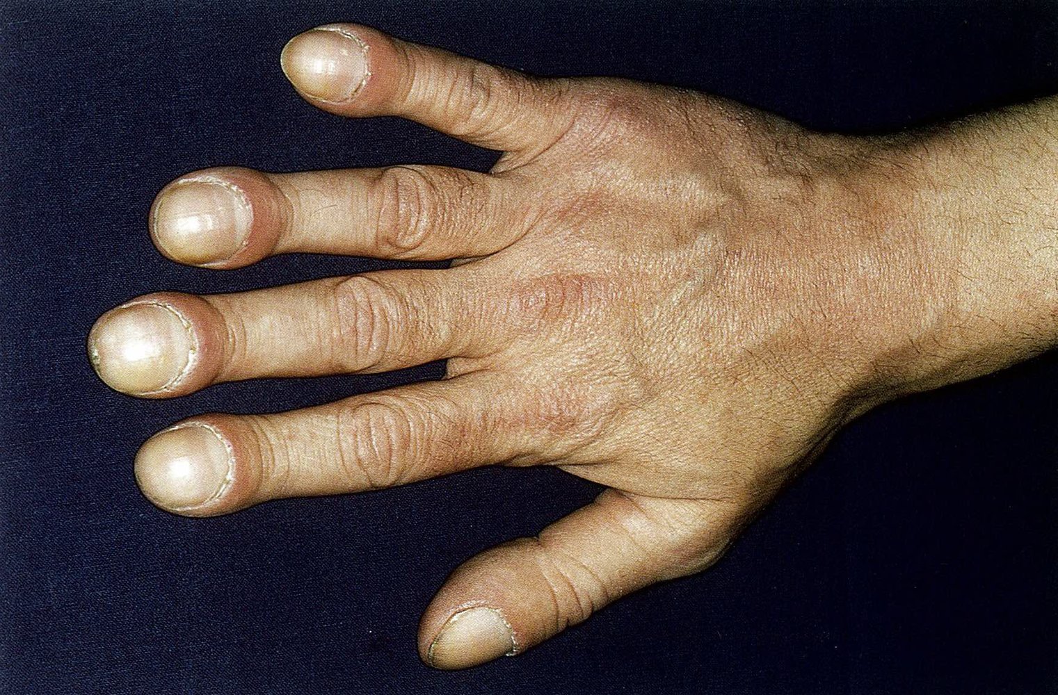 Hippocratic nails and finger clubbing