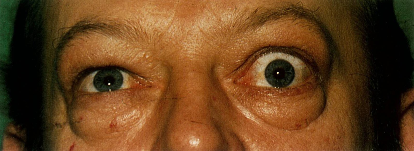 Graves' ophthalmopathy