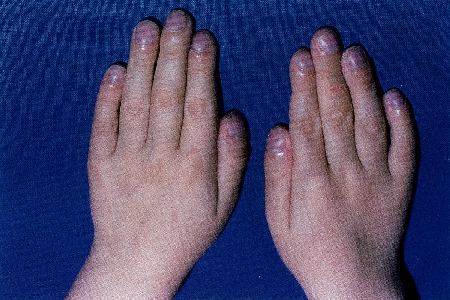 Finger clubbing and hippocratic nails in cystic fibrosis