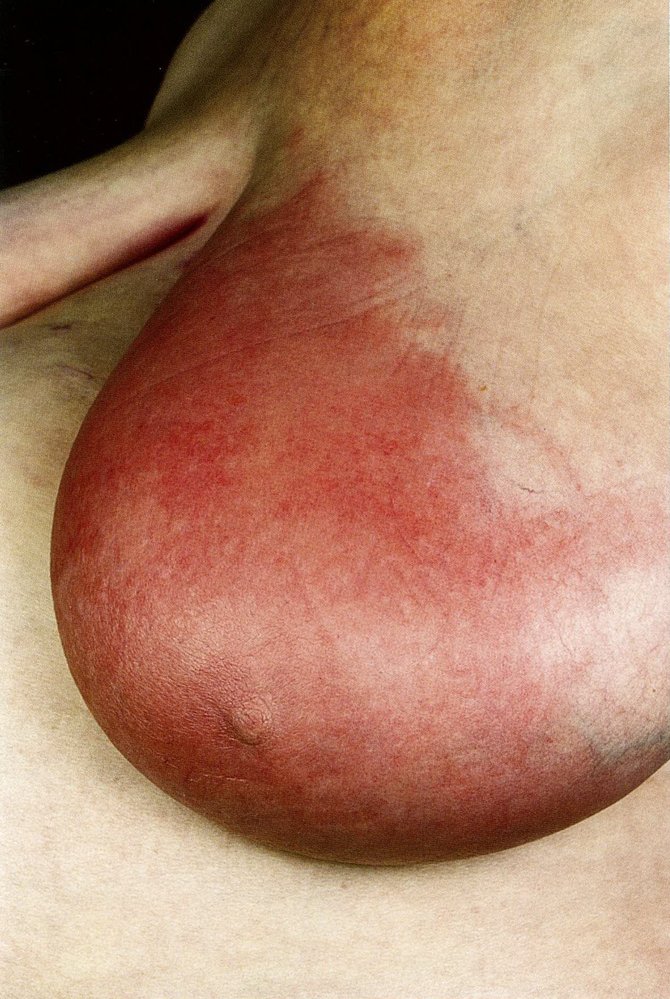Erysipelas of the breast