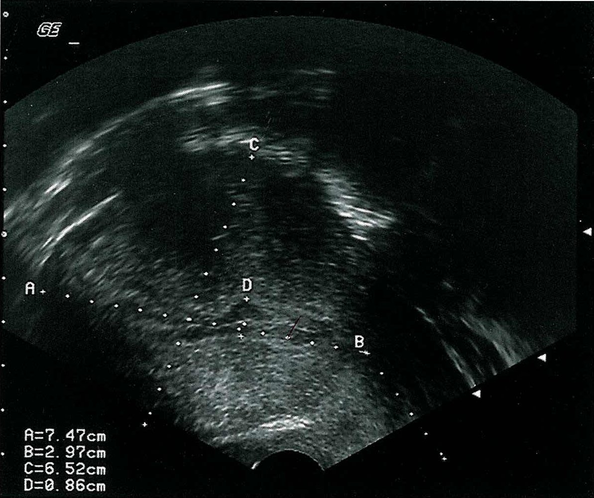 Uterine leiomyoma