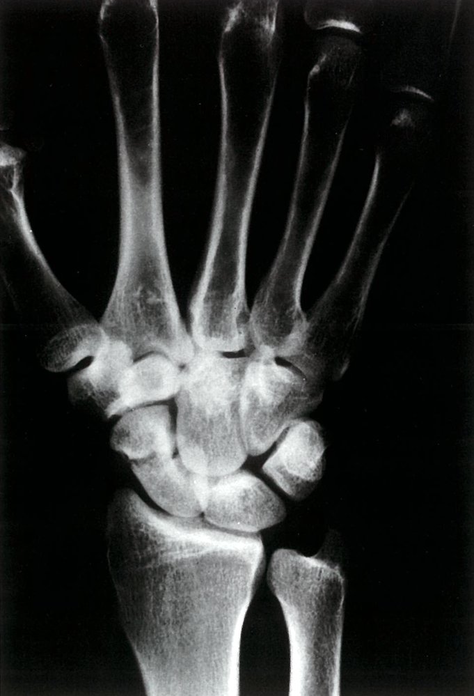 Scaphoid fracture
