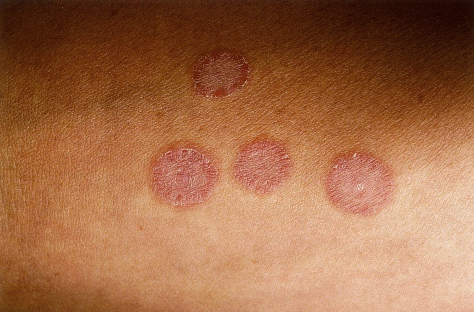 Tinea corporis (ringworm)