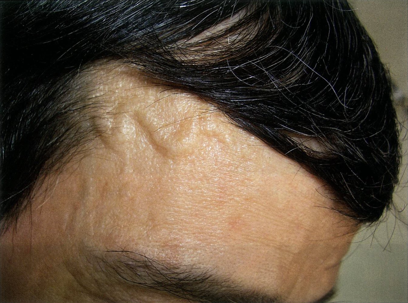 Giant cell arteritis