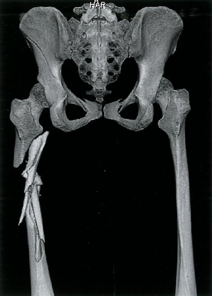 Subtrochanteric fracture of the left femur, type C