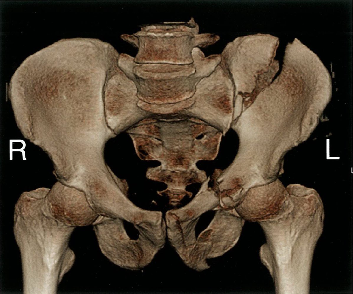 Left-sided pelvic fractures