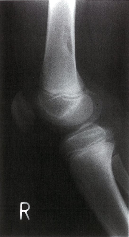 Nonossifying fibroma