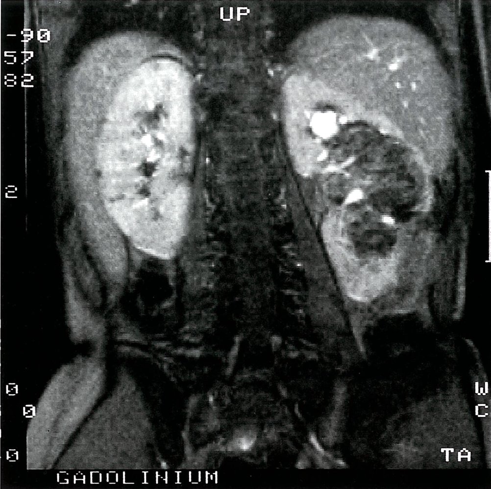 Large angiomyolipoma associated with tuberous sclerosis