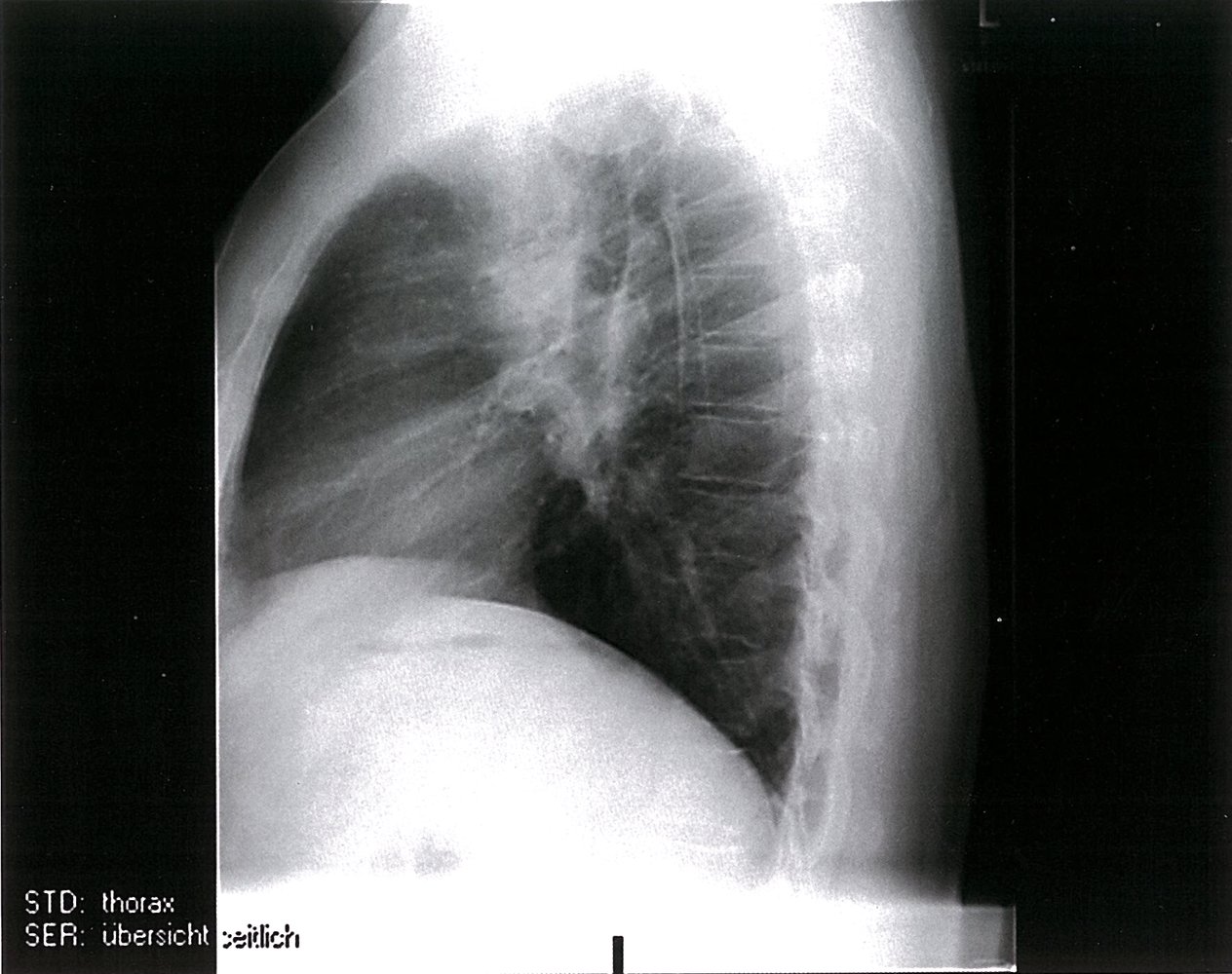 Pulmonary sarcoidosis (Type I)