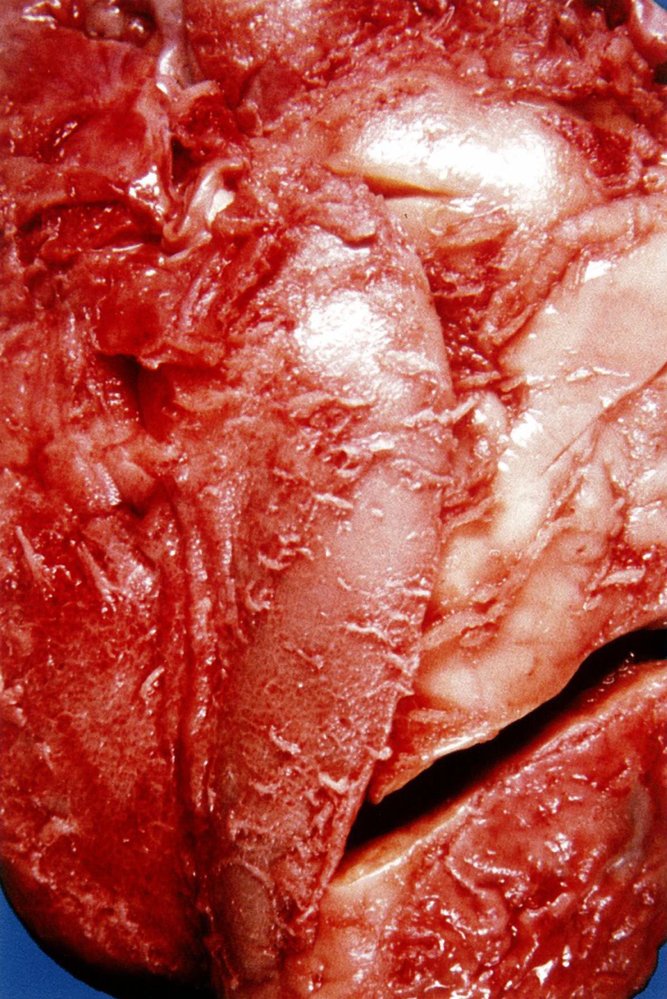Fibrinous pericarditis