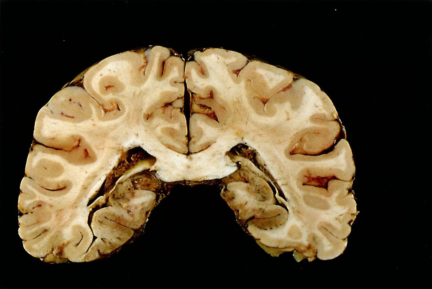 Bilateral ischemic stroke in the calcarine sulcus